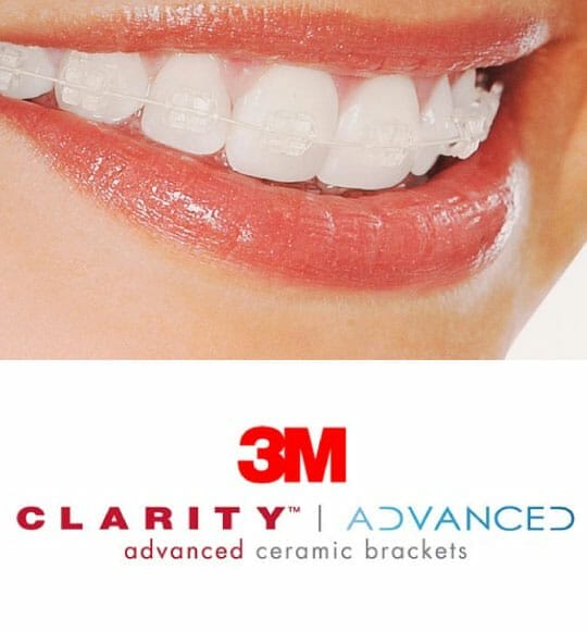 Ceramic braces | MyHealthcare Clinic