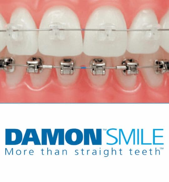 Damon braces | MyHealthcare Clinic