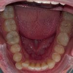 Bottom teeth before Invisalign | MyHealthcare Clinic