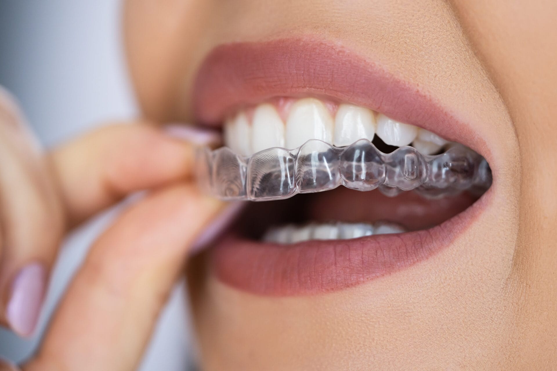 How does Invisalign work with MyHealthcare Clinic.